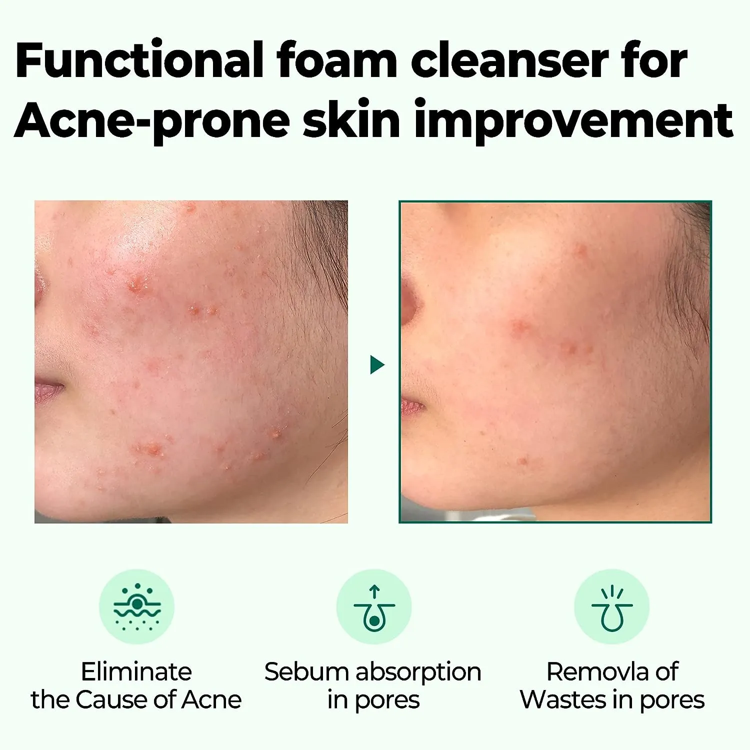 AHA BHA PHA 30 Days Miracle Acne Clear Foam 100ml